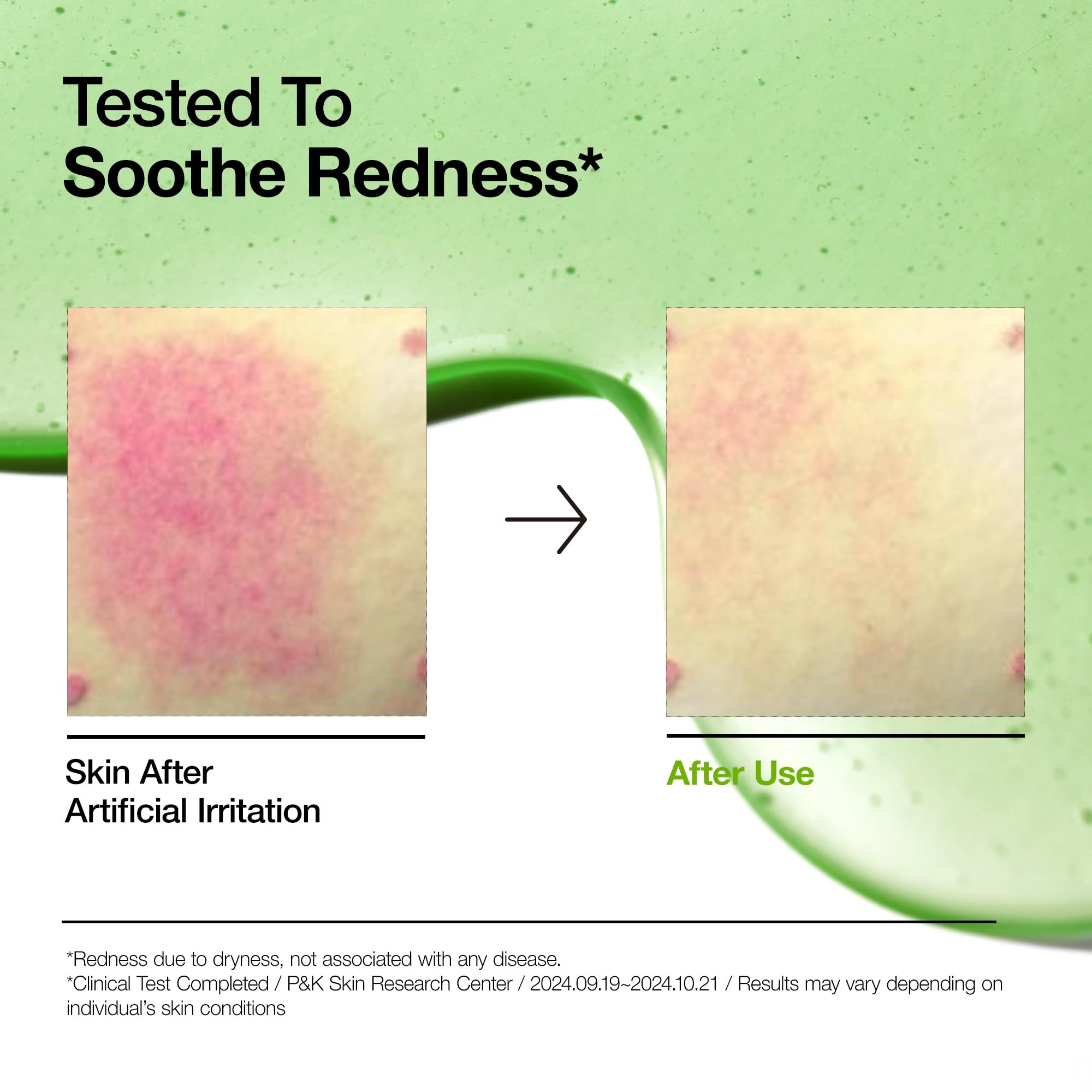 Anua Azelaic Acid 10 Hyaluron Redness Soothing Serum, Facial Serum for Sensitive skin, Hyaluronic Acid, Niacinamide, Spot Care, Natural Color, Vegan, Korean Skincare (30ml) - Image 3