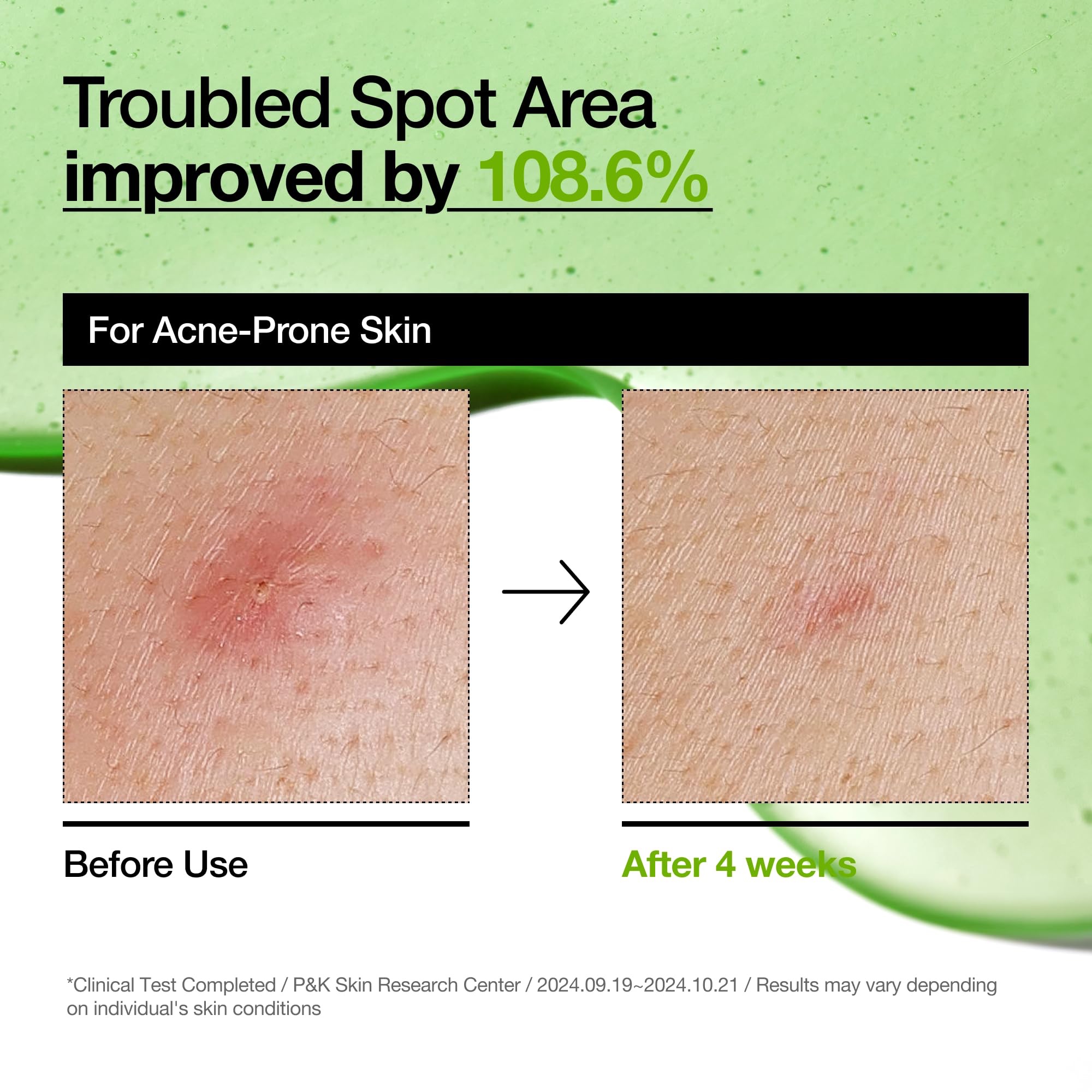 Anua Azelaic Acid 10 Hyaluron Redness Soothing Serum, Facial Serum for Sensitive skin, Hyaluronic Acid, Niacinamide, Spot Care, Natural Color, Vegan, Korean Skincare (30ml) - Image 5